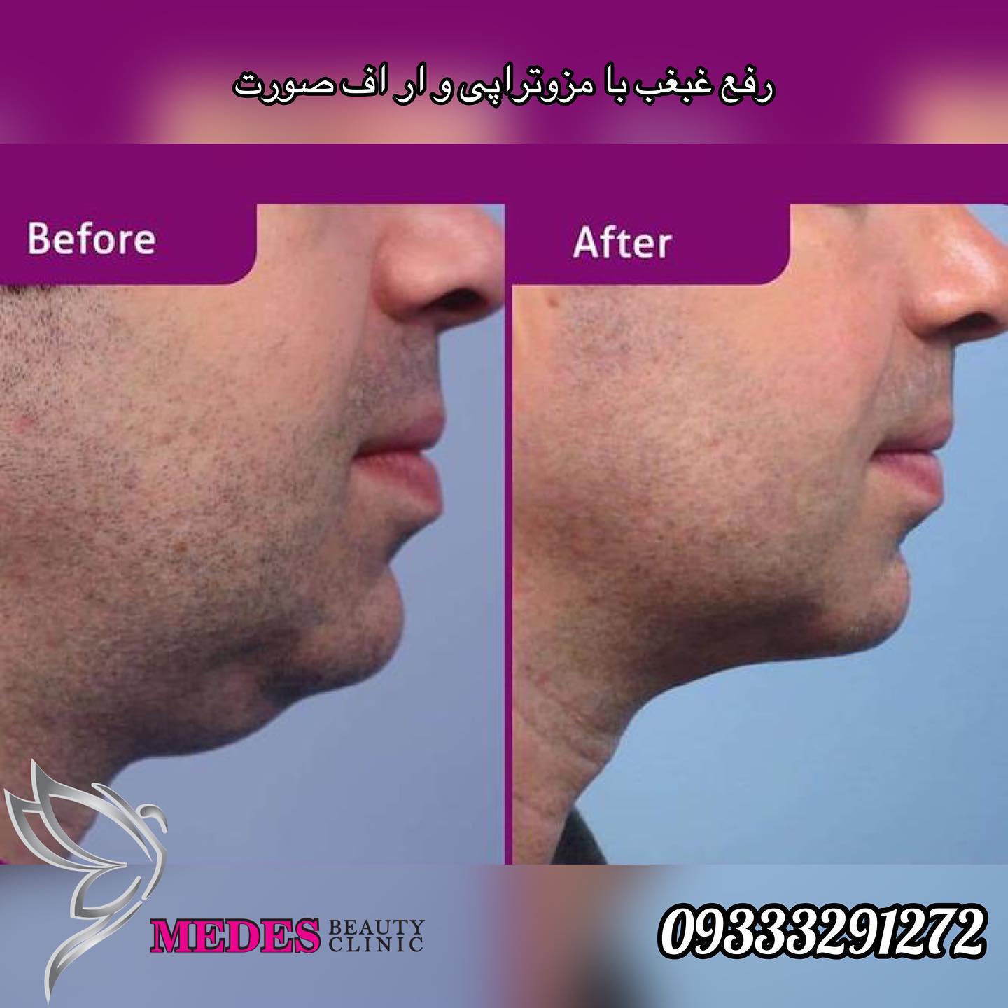 گالری مزوتراپی